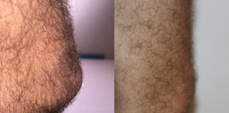 A comparison between a plumber’s knee (left) and that of an office worker